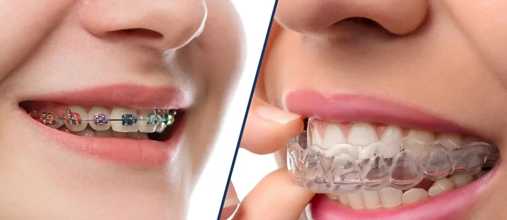 bracesandaligners