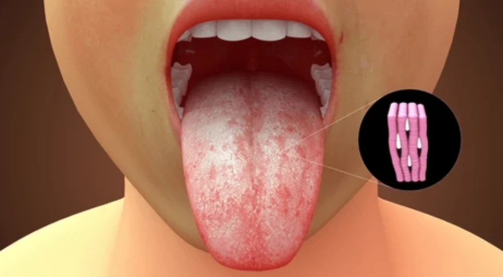 oralcancerimg