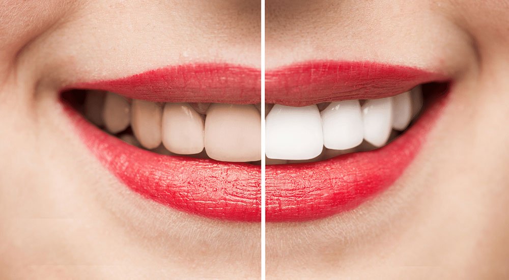 teethbleachingimg1